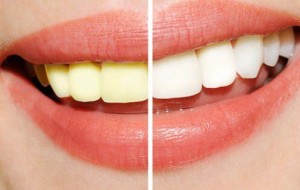 Tẩy trắng răng đơn giản tại nhà